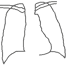 胸部Ｘ線写真の模式図